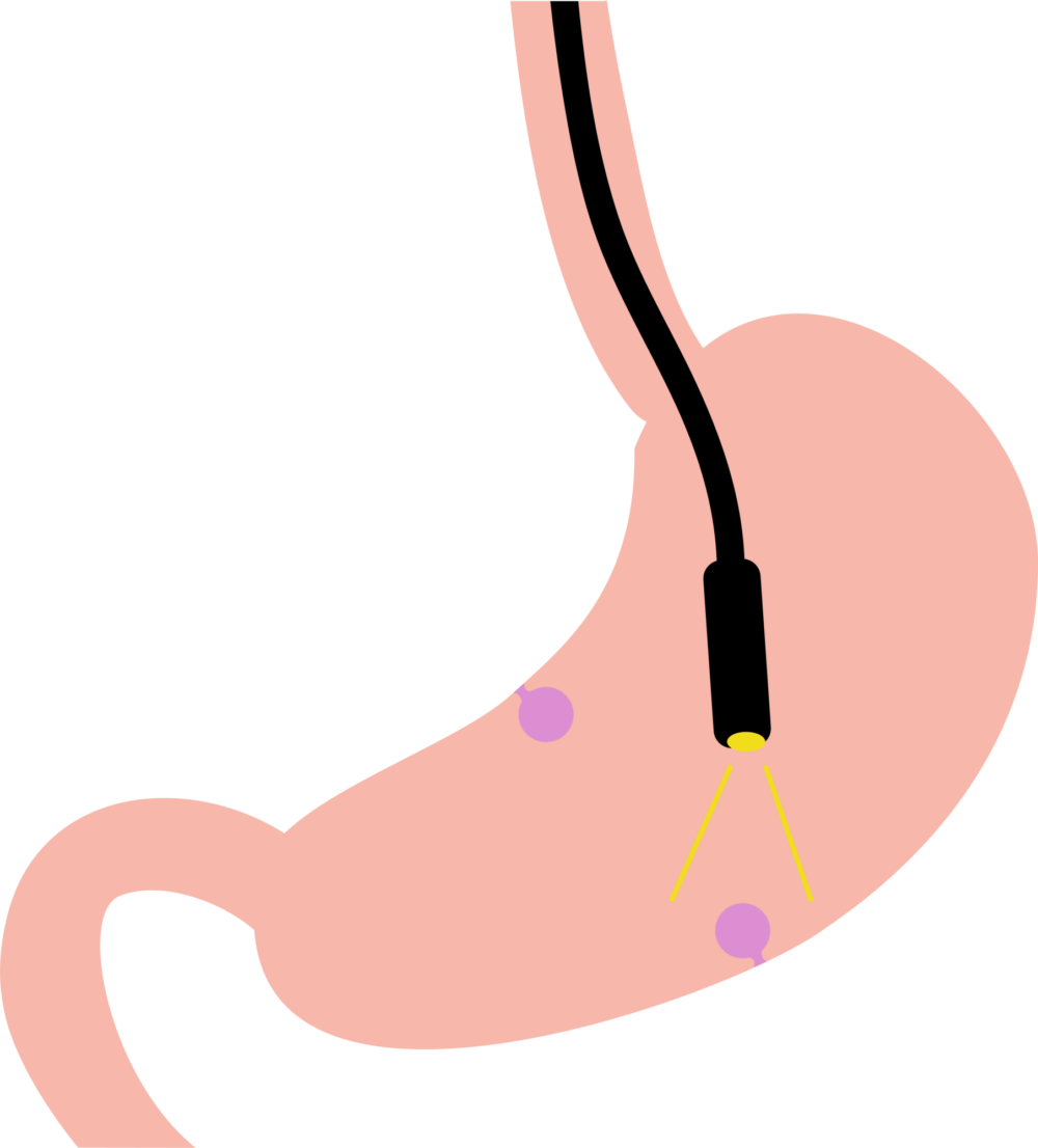 胃カメラとは