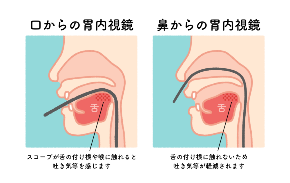 細いカメラを鼻から挿入することで不快感を軽減