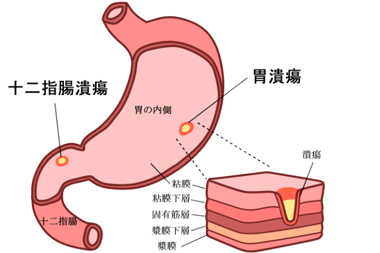 胃潰瘍、十二指腸潰瘍について