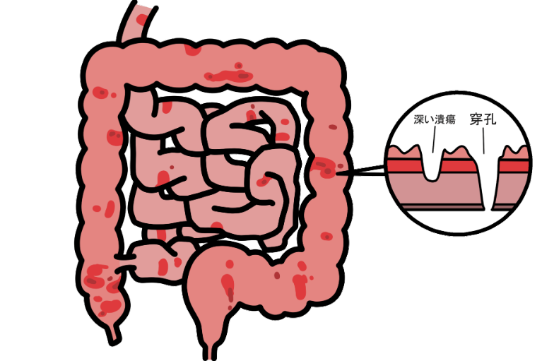 クローン病