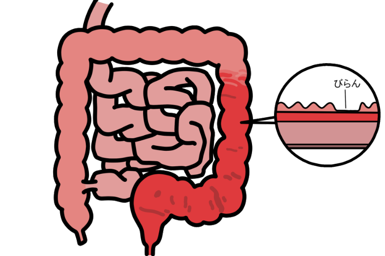 潰瘍性大腸炎